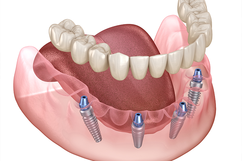 All-On-4 Implants in Oakland