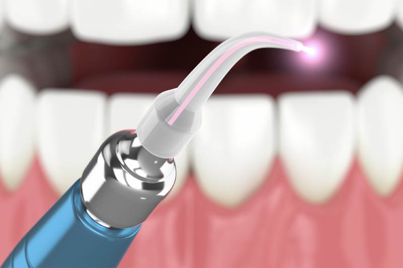 Laser Dentistry in Oakland